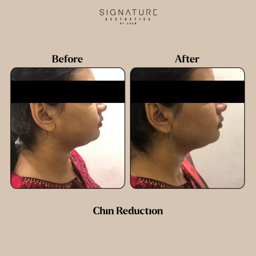Chin Reduction