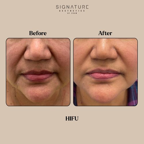 HIFU Before & After