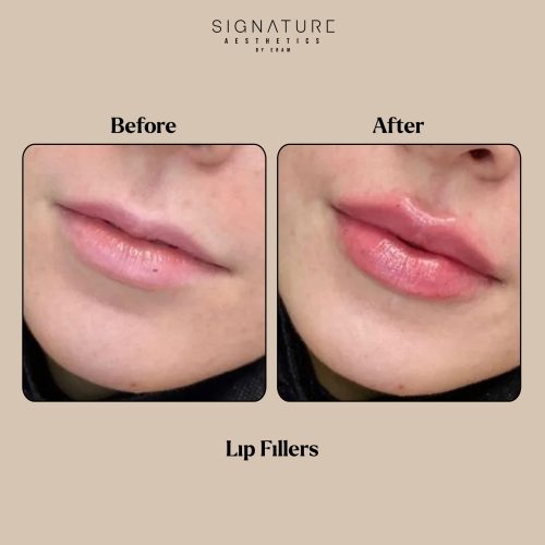 Lip Fillers Before & After