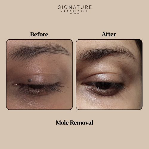 Mole Removal