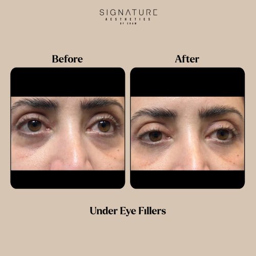 Under Eye Fillers Before & After